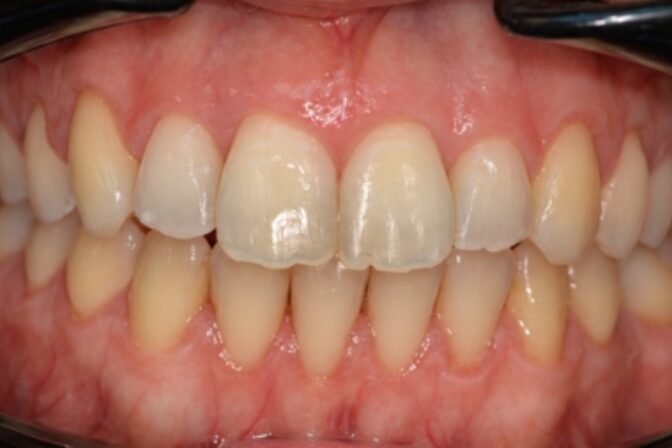 Orthodontics - Case 4 after
