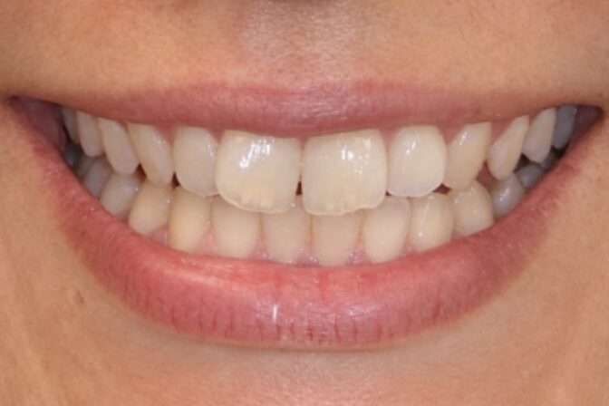Smile Makeover - Orthodontics and Composite Bonding before