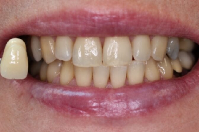 Teeth Whitening - Case 1 before