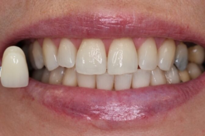 Teeth Whitening - Case 1 after