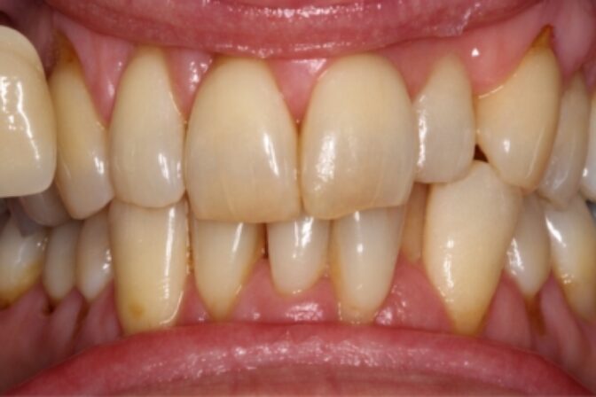 Teeth Whitening - Case 2 before