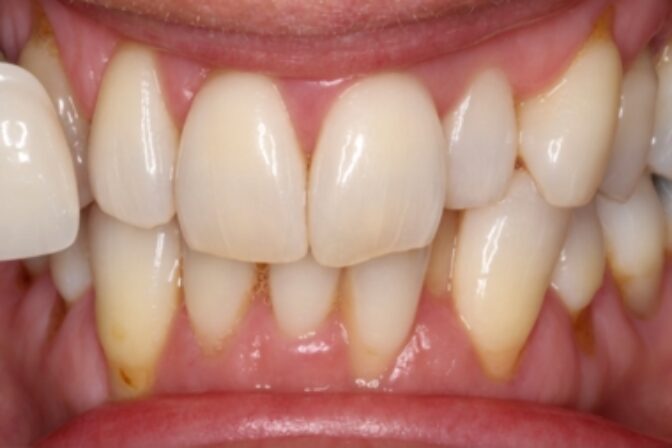 Teeth Whitening - Case 2 after