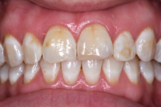 Teeth Whitening - Case 3 before