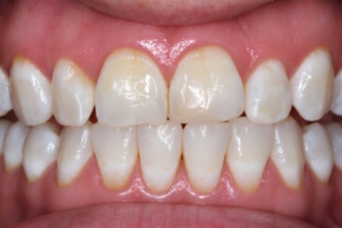Teeth Whitening - Case 3 after