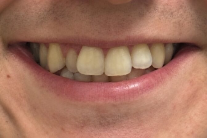 Smile Makeover - Orthodontics and Composite Bonding - Case 2 before