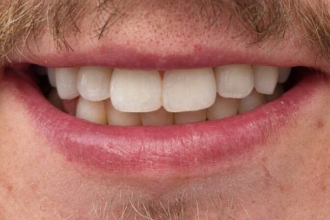 Smile Makeover - Orthodontics and Composite Bonding - Case 2 after