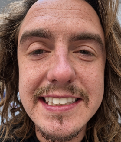 Smile Makeover - Orthodontics and Composite Bonding - Case 2 face after