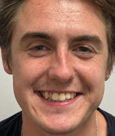 Smile Makeover - Orthodontics and Composite Bonding - Case 2 face before