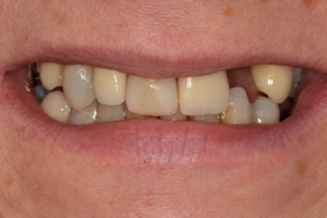 Smile Makeover - Case 6 before