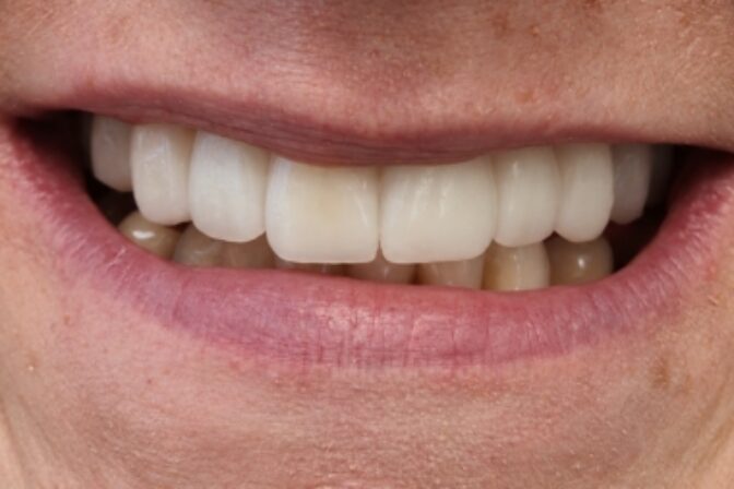 Smile Makeover - Case 6 after