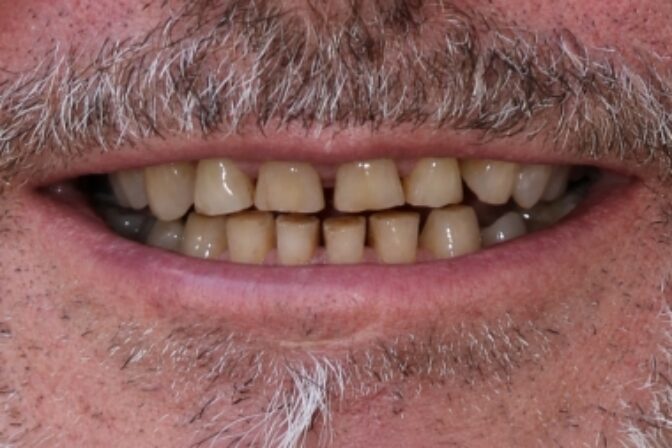 Smile Makeover - Case 7 before