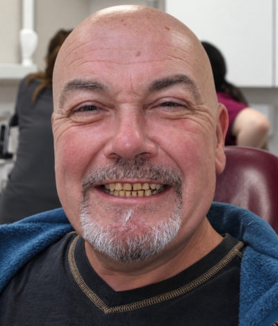 Smile Makeover - Case 7 face before
