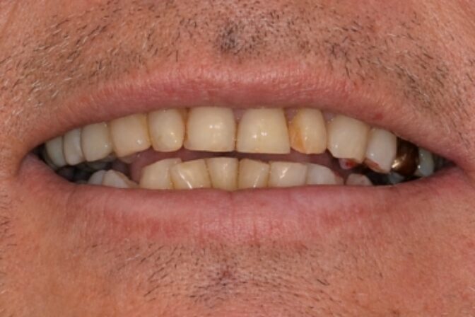 Smile Makeover - Case 8 before