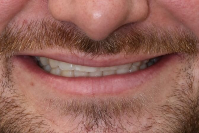 Tooth Wear - Case 4 before