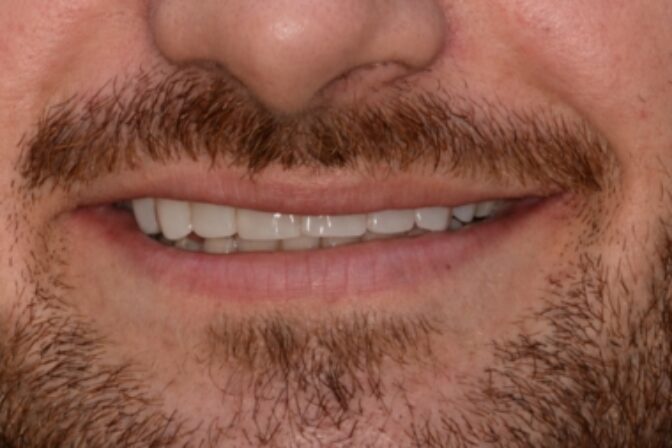 Tooth Wear - Case 4 after