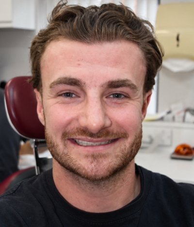 Tooth Wear - Case 4 face before