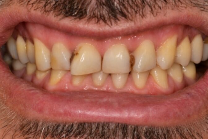 Smile Makeover - Case 11 before