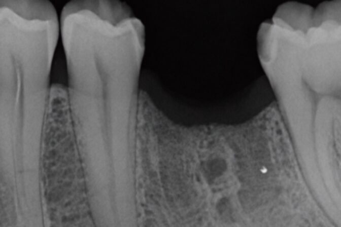 Dental Implants - Case 3 before