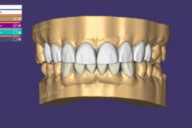 Digital Smile Design - Case 1 Digital after