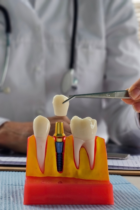 Benefits of guided implant surgery